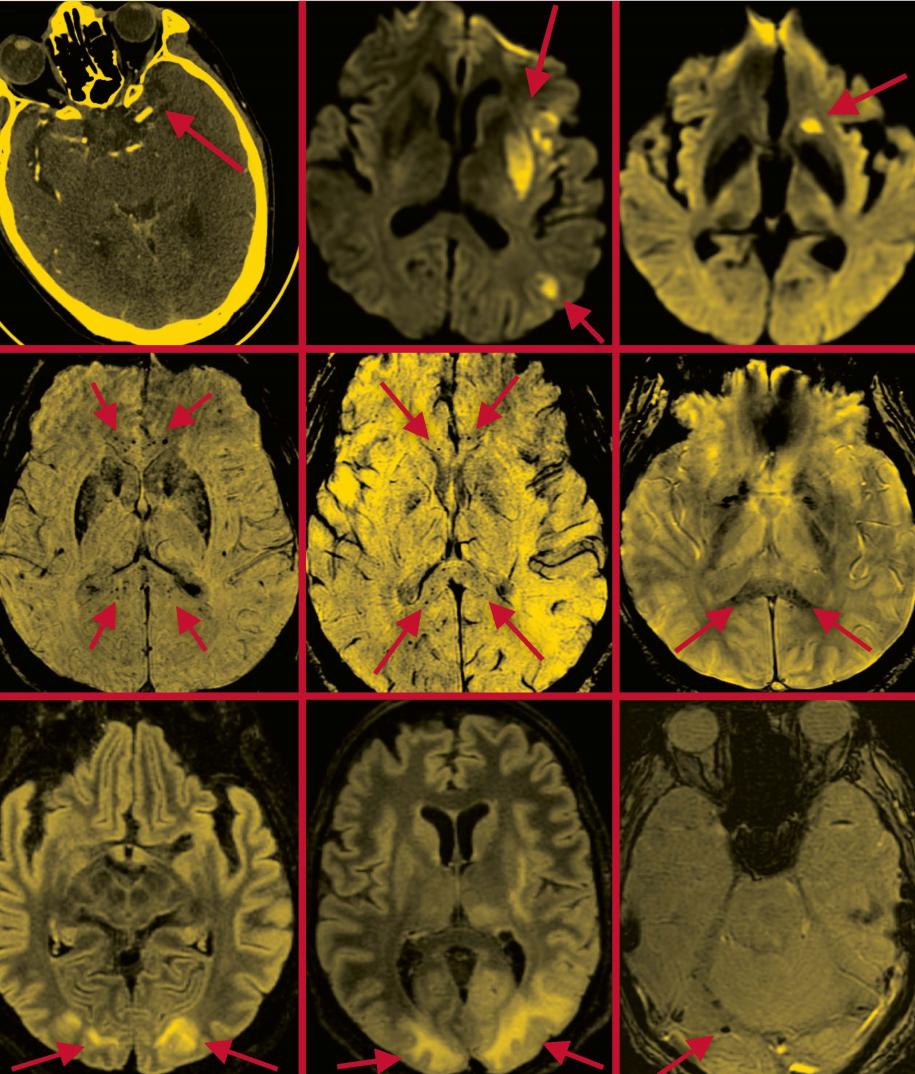 Scans that appeared in a paper Navi co-authored in the American Journal of Neuroradiology depict the brains of COVID-19 patients suffering from stroke (top row); microhemorrhages in the corpus callosum region (middle row); and posterior re brain scans